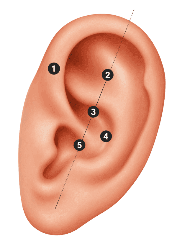 Five NADA acupuncture points shown on the outer ear.